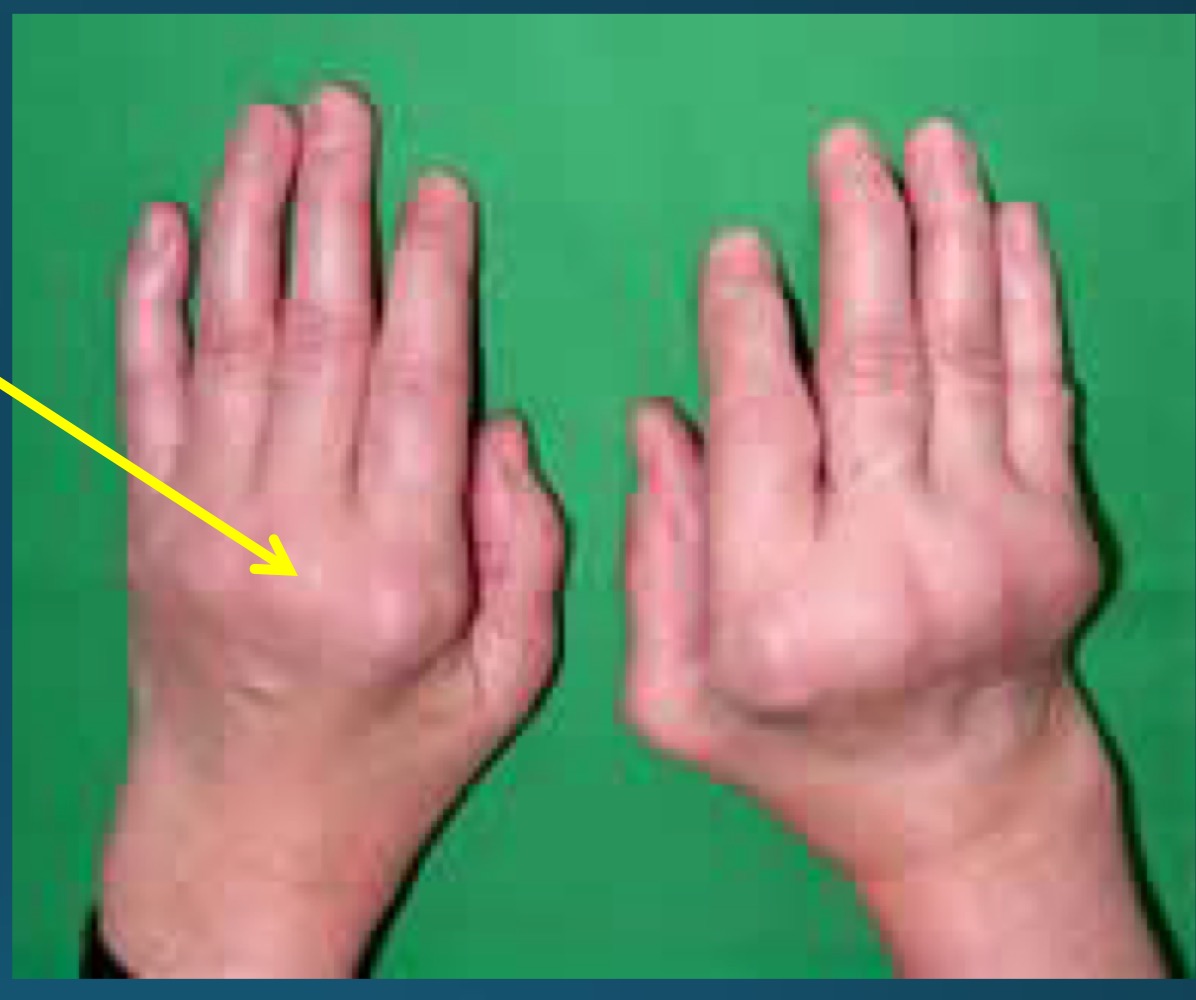 <p>What are these called and what is it a common clinical feature of ? </p>