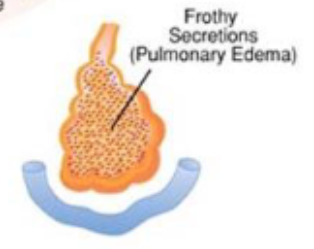 <ul><li><p>frothy secretions</p></li><li><p>often due to left-sided heart failure</p></li><li><p>pink frothy sputum</p></li></ul><p></p>