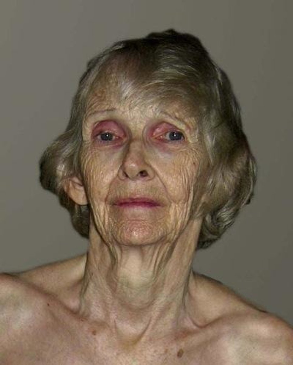 <p>Cachectic appearance</p>