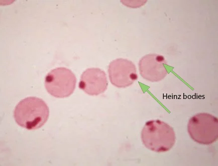 <p>Large aggregate of oxidized/precipitated hemoglobin that are attached to the internal surfaces of erythrocytes</p>