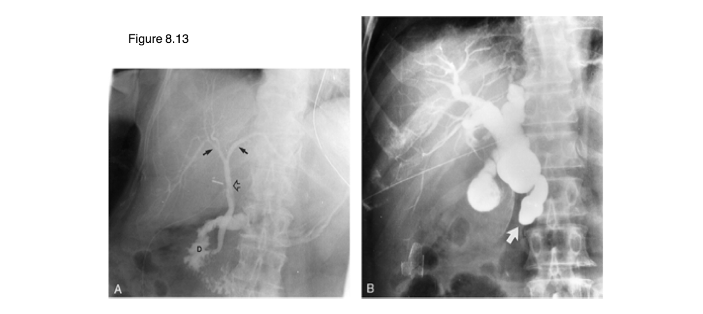<p>polypoid lesion</p>