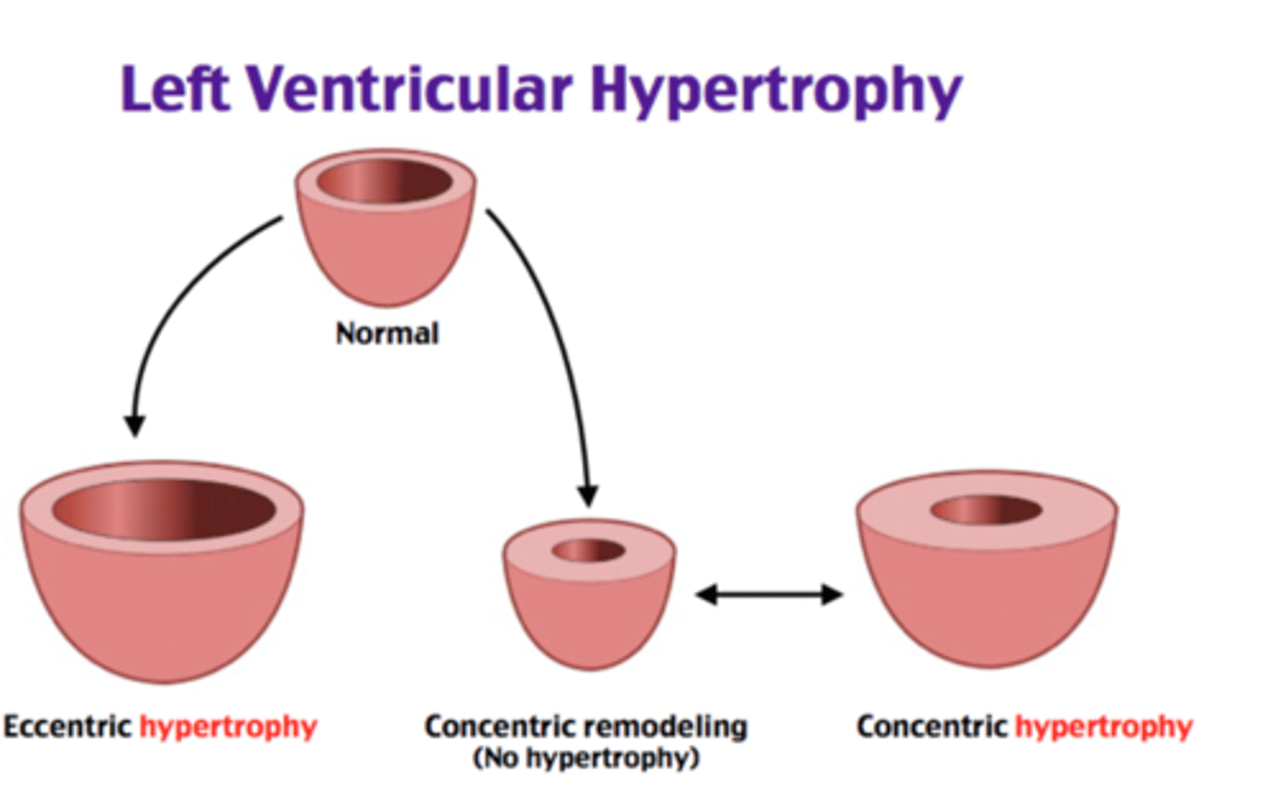 <p>changes in mass, volume, and shape allows heart to compensate for increased lode</p><p>- primarily stimulated by pressure overload</p><p>- increased wall stress leads to: thickening of individual myocytes, replication of sarcomeres, elongation of myocytes, and ventricular dilation</p><p>- with chronic volume-overload, the ventricle becomes more spherical and causes valve defects</p>