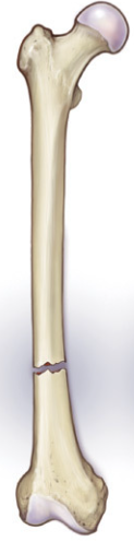 <p><span>where the fracture line runs perpendicular to the long axis of the bone</span></p>