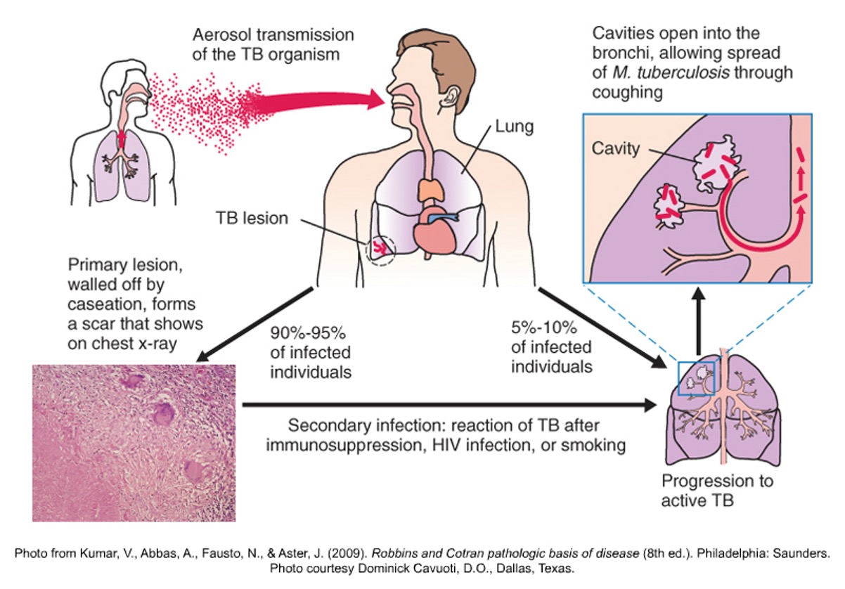 <p>TB infection</p>