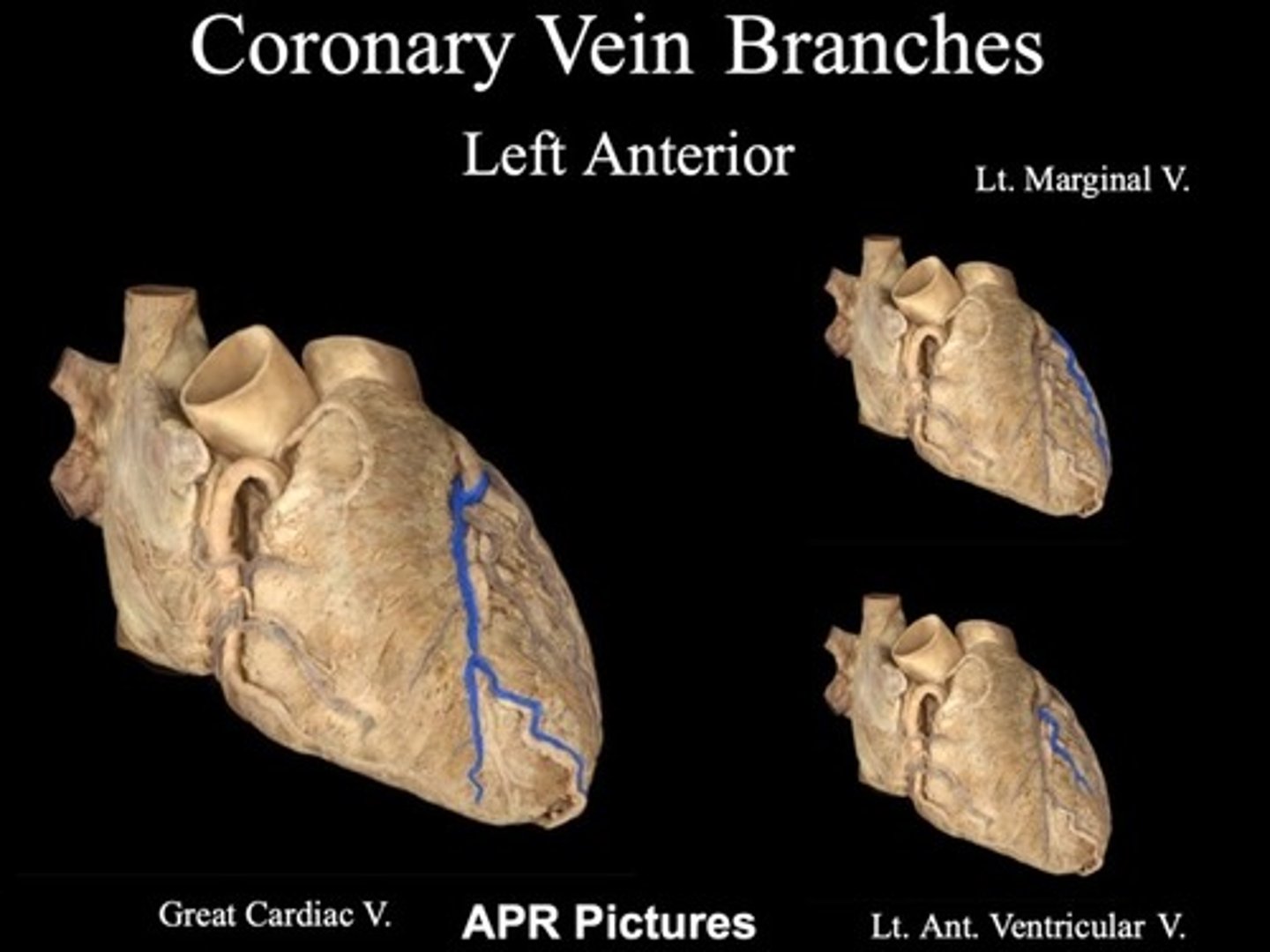 <p>great cardiac vein</p><p>left marginal vein</p><p>left anterior ventricular vein</p>