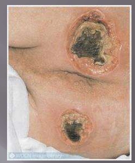 <p>Pressure Injury- Unstageable </p>