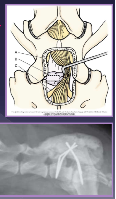 <ul><li><p>medical </p><ul><li><p>pain medication </p><ul><li><p>gabapentin </p></li><li><p>NSAID </p></li></ul></li><li><p><strong>rest* </strong></p></li><li><p>epidural steroid injections </p><ul><li><p>methylprednisolone acetate x3 injections </p><ul><li><p>initial 2 weeks, 6 weeks </p></li></ul></li><li><p>79% improved; 50% resolved pain </p></li></ul></li><li><p>appropriate bedding </p></li><li><p>bladder control (if needed) </p></li></ul></li><li><p>surgical </p><ul><li><p>goal </p><ul><li><p>decompression </p></li><li><p>pain relief </p></li><li><p>axonal regeneration </p></li></ul></li><li><p>laminectomy + discectomy </p></li><li><p>distraction and stabilization </p></li></ul></li><li><p>prognosis and outcome </p><ul><li><p>laminectomy and discectomy </p><ul><li><p>70-80% success rate </p></li></ul></li></ul></li><li><p>best surgical outcome </p><ul><li><p>mild disease </p></li><li><p>50% success rate with severe neurologic signs </p></li></ul></li><li><p>recurrence </p><ul><li><p>new bone formation </p></li><li><p>scar tissue formation </p></li></ul></li></ul><p></p>