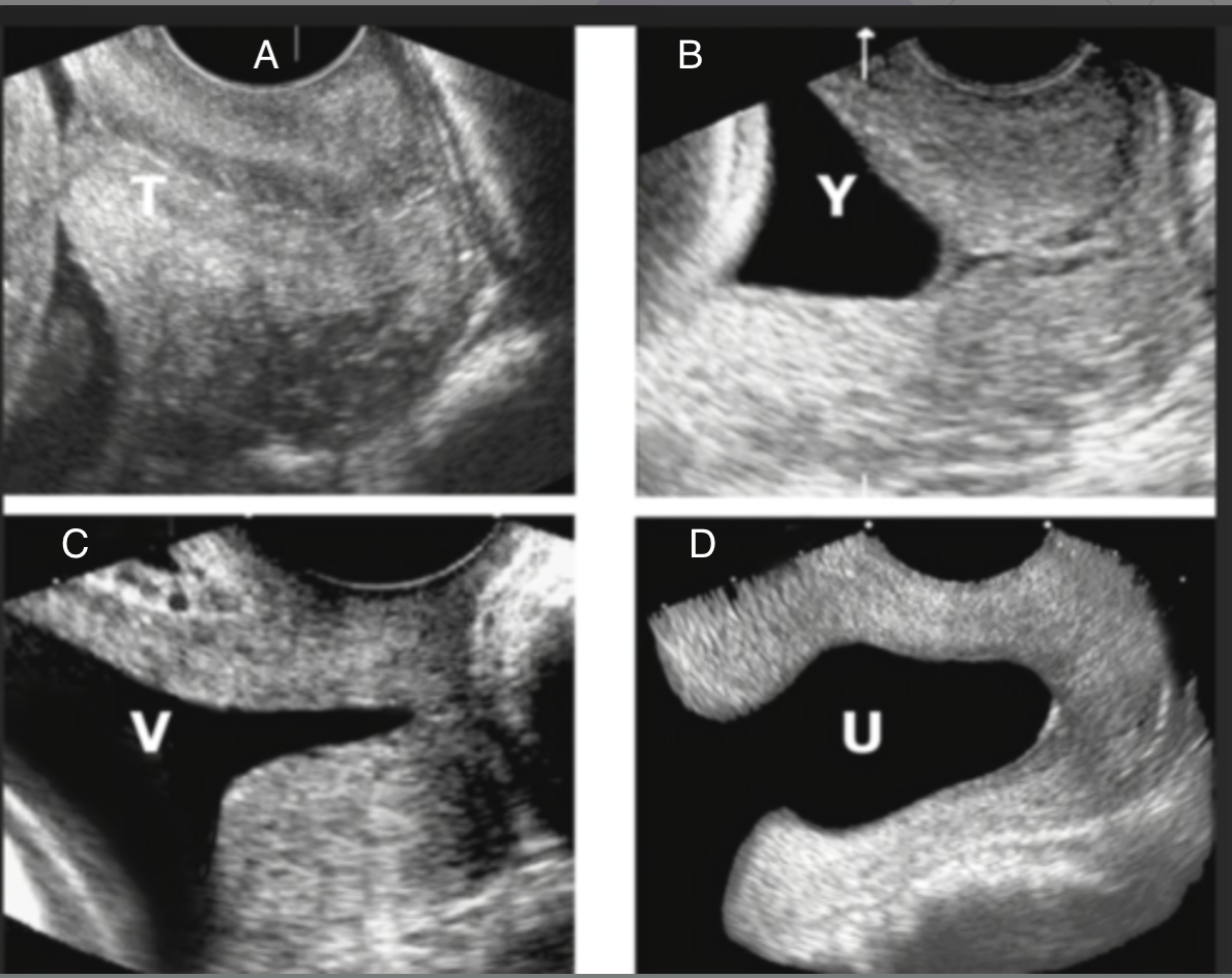 <p>which shows funneling of the cervix</p><p>a) C + D</p><p>b) A + B</p><p>c) D only</p><p>d) B, C, D</p>