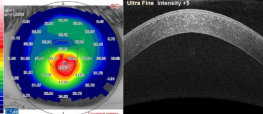 <ul><li><p>an eye with no topographic findings</p></li><li><p>NO slit lamp findings and KCN in the fellow eye</p></li></ul>