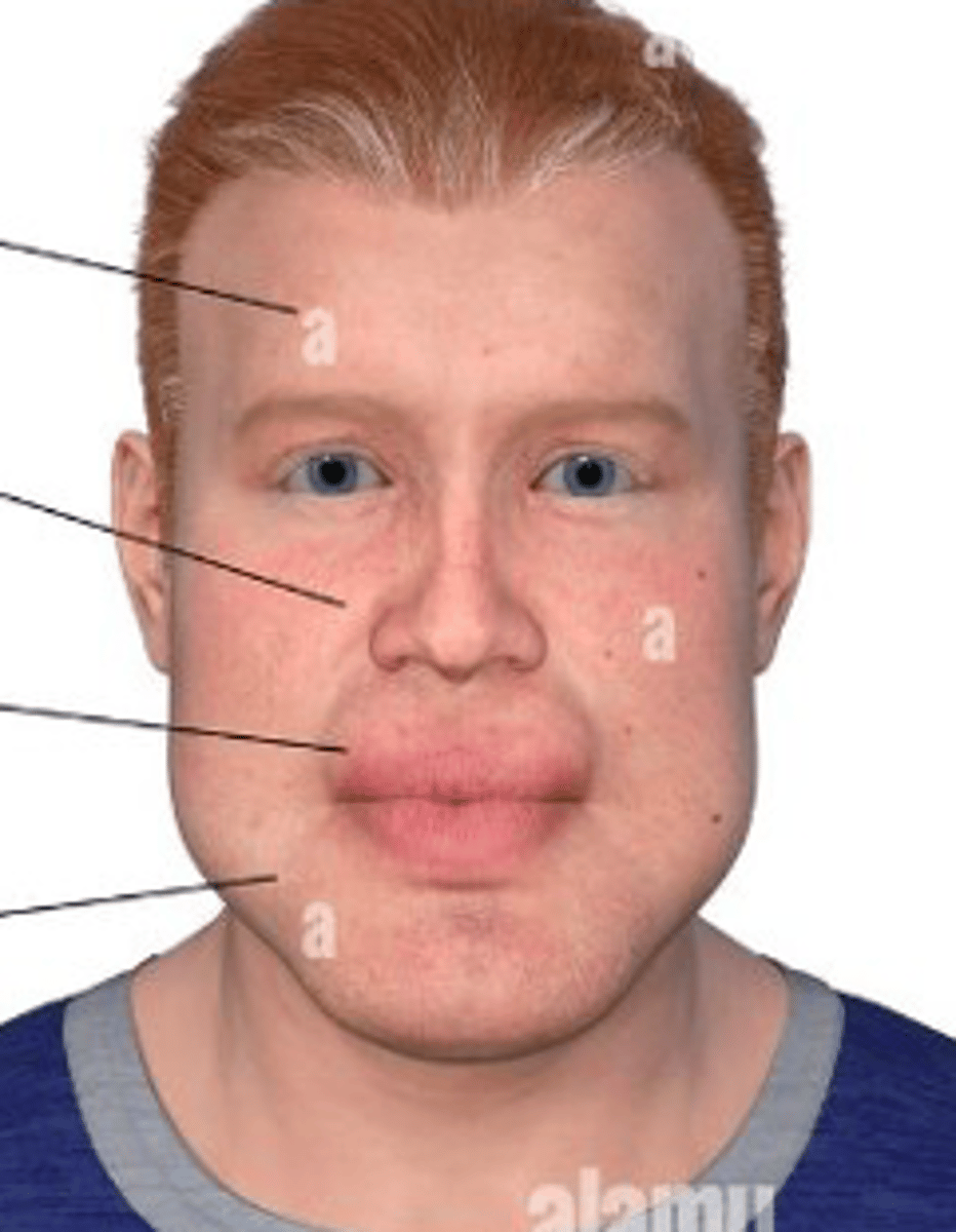 <p>abnormal enlargement of the extremities (i.e. enlarged nose/lips/tongue, prominent forehead and chin/jaw)</p>