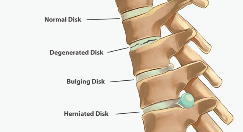<p>degenerative disc gets brittle </p><p>bulging in the soft tissue moves further out and eventually becomes herniated </p><p>THE problem is the disc starts to push on the nerve leading to a bunch of symptoms like neuropathy, burning senstion </p>