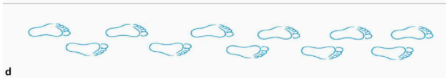<p>Describe the walk (and the etiology)</p>