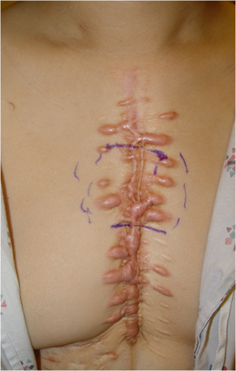 <p><span>raised scar due to collagen overproduction </span></p><p><span>scar extends outside the boundaries of the wound</span></p><p></p>