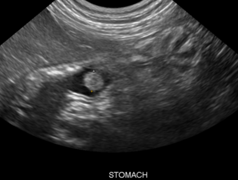 <p>-need to remove polyps to relieve obstruction (endoscopic electrocautery or surgical removal)</p><p>-follow with a 4wk tapering course of prednisone</p><p>-consider hypoallergenic food for tx of chronic gastritis</p>