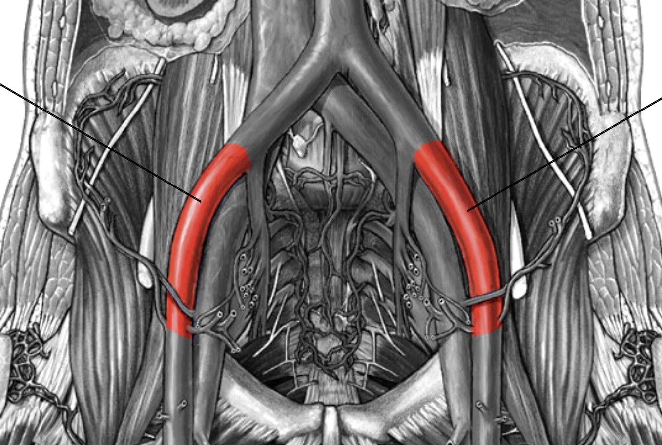 <p>Which arteries:</p><ul><li><p>Extends from common iliac (L&amp;R) arteries</p></li><li><p>Lateral to internal iliac artery</p></li></ul><p></p>