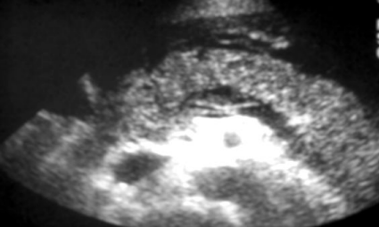 <p>Hemorrhagic pancreatitis (high mortality rate) *see image</p><p>Ruptured pseudocyst</p><p>Phlegmonous pancreatitis</p>