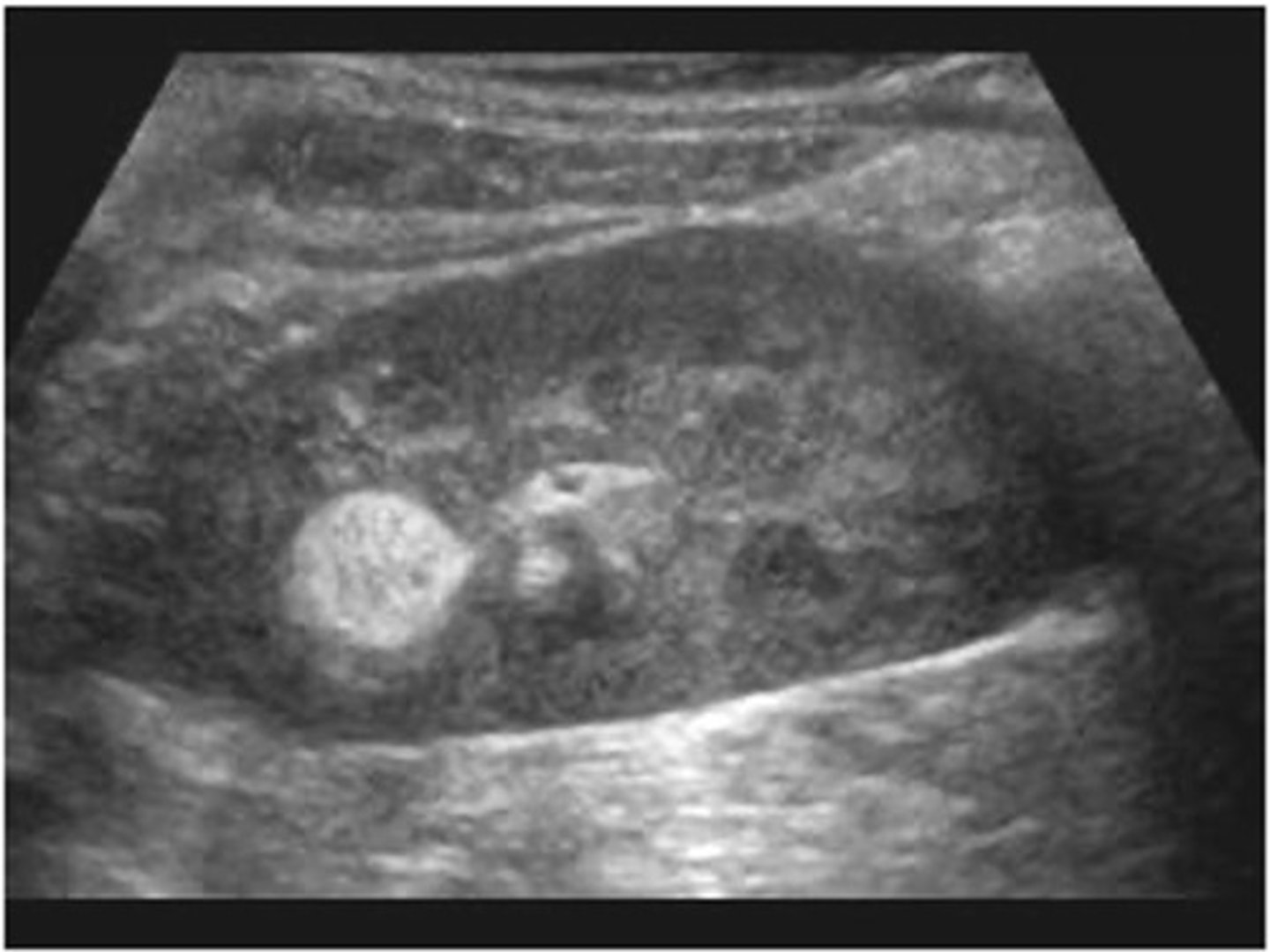 <p>Sonographically, renal angiomyolipoma (AML) appears ___ </p>