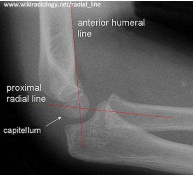 <p><strong>Interpreting Elbow X-Rays</strong></p><p>-Order __ and lateral films </p><p>-Anterior Humeral Line → should pass through the ______ of the _________</p><ul><li><p>If it doesn’t, then there is a supracondylar fracture present </p></li></ul><p>-Radio-capitellar line → should pass through the ______ of the capitellum</p>