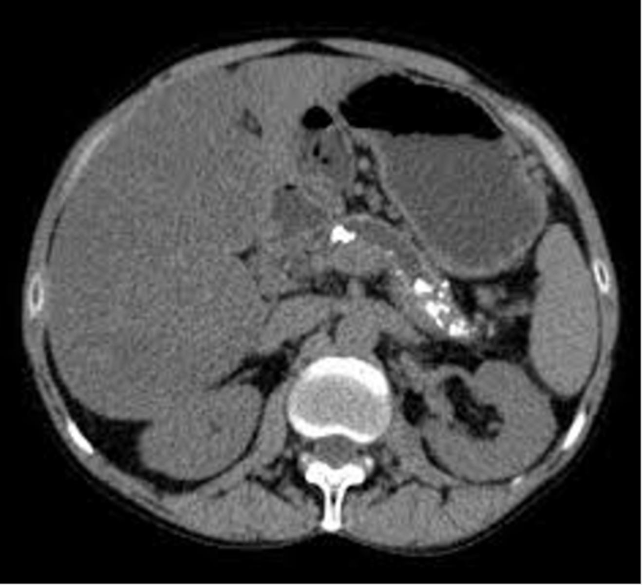 <p>Define Condition:</p><p>Inflammation, fibrosis, and loss of acinar and islet cells</p><p>-Sx/PE:</p><p>&gt; Epigastric pain radiating to back</p><p>&gt; Steatorrhea</p><p>-Dx:</p><p>&gt; Labs = </p><p>&gt;&gt; Exocrine/Endocrine Insufficiency</p><p>&gt;&gt; Soluble Vitamin Deficiency</p><p>&gt; Imaging = (CT Abd/EUS)</p><p>&gt;&gt; Dilated pancreatic duct</p><p>&gt;&gt; Pancreatic duct calcifications</p><p>-Tx:</p><p>&gt; Pancreatic enzyme replacement</p><p>&gt; Pain Mgmt</p><p>&gt; Surgery</p>