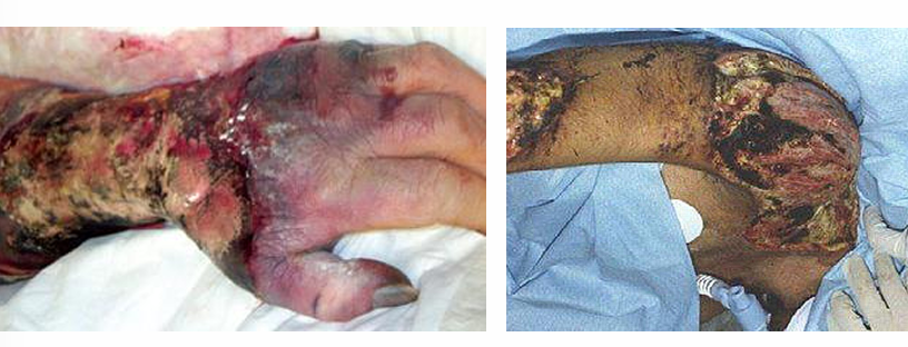 <p>-often in immunologically normal individuals</p><p>-result of direct inoculation of fungal into skin</p><p>-source often soil although nosocomial exposures have been reported</p><p>-from the skin, fungus invades through muscle, fascia, and bone</p><p>-while aggressive surgical therapy can be curative, rapidly progressive infection has &gt;80% mortality</p>