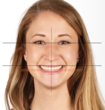 <p>Lower border of lip as it related to teeth and gingival tissues</p><p>Average lip line exposes upper teeth and interdental papilla</p><p>High- gummy smile</p><p>Low- no gingival tissues</p><p>Within 2mm apical to height of gingival margin of max centrals</p>