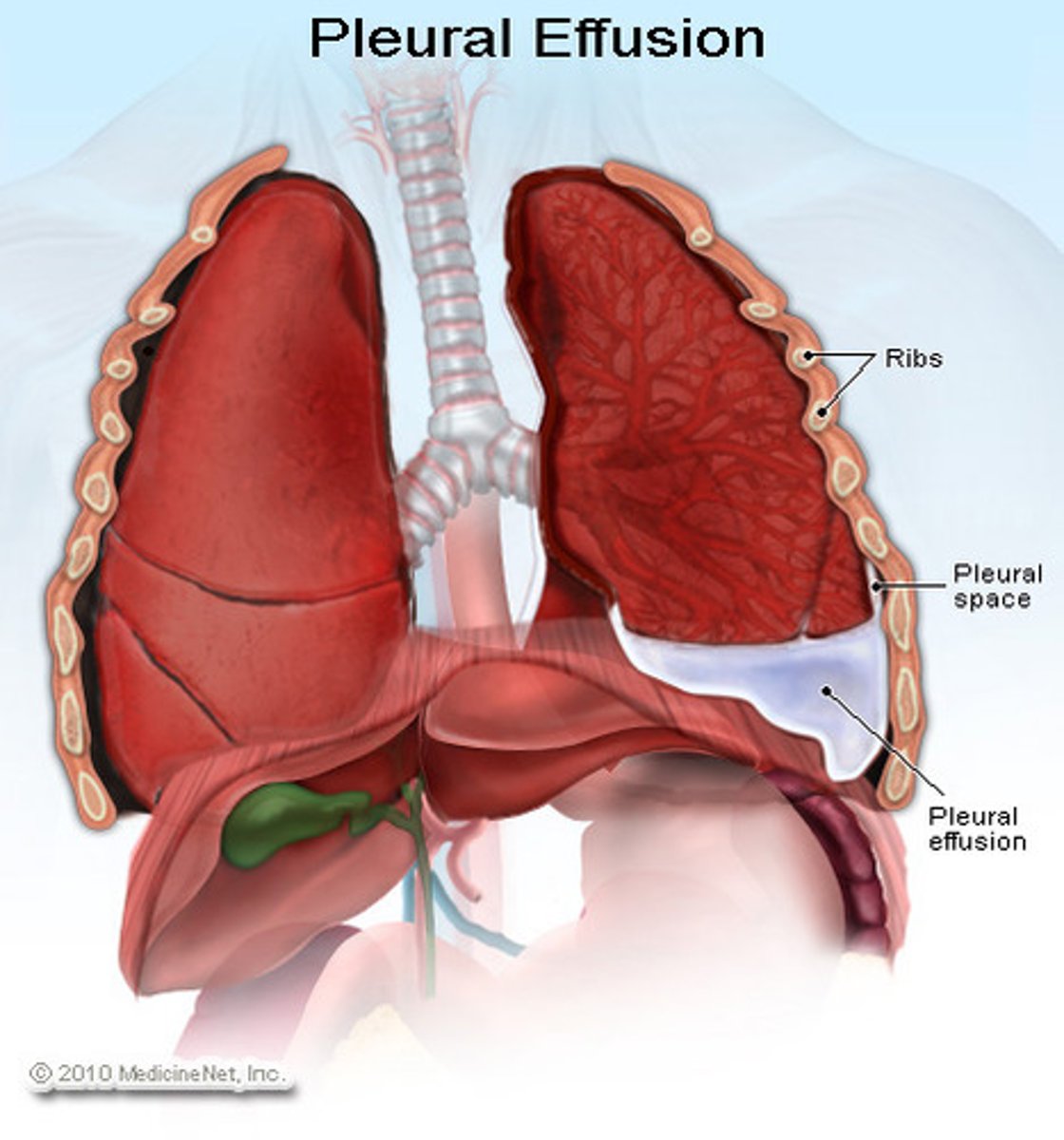 <p>fluid in the pleural space</p>