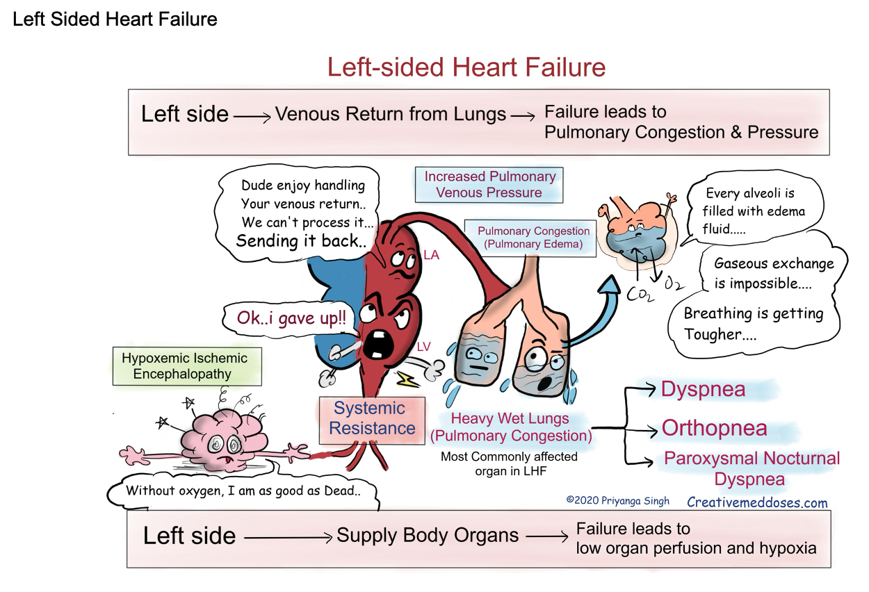 <ul><li><p>Systolic: coronary artery disease, MI, dilated cardiomyopathy, myocarditis, acidosis, hyperkalemia, aortic valve stenosis and regurgitation, hypervolemia&nbsp;</p></li><li><p>Diastolic: restrict cardiomyopathy, LVH, pericarditis, tamponade, mitral stenosis (all increase ESV and pressure, back up blood flow into pulmonary circulation)</p></li><li><p>#1 cause of LHF = CAD/MI</p></li><li><p>Common cause of RHF (blood backs up to heart) = symptoms of everything&nbsp;</p><ul><li><p>Left side failed, back up into lungs, eventually into right side </p></li></ul></li></ul><p></p>