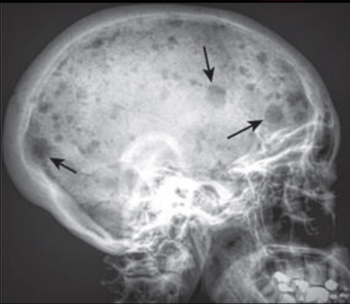 <p>diffuse lytic lesions in skull - think?</p>