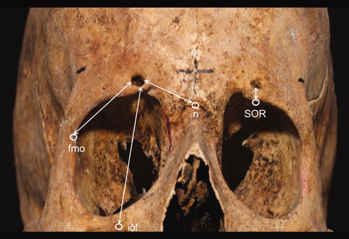 <p>name this bone or bone marking?</p>