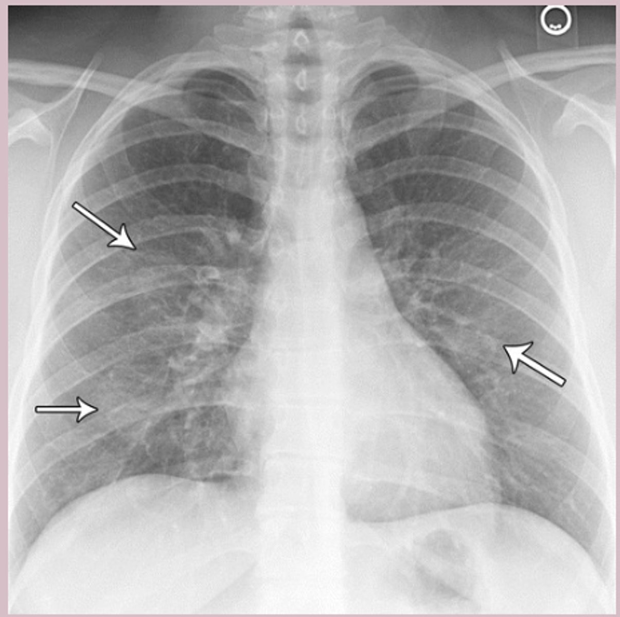 <p>-clinical </p><p>-confirmatory- nasal PCR</p><p>-CXR (rule out): patchy atelectasis, patchy interstitial infiltrates, peribronchial cuffing, hyperinflation </p>