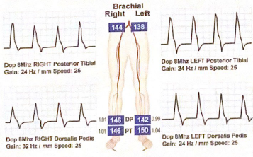 <p>What would be the interpretation for this case? Describe the pedal waveform patterns and categorize the severity of the ABI</p>