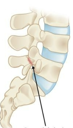 <p><strong>What is Spondylolysis?</strong></p>