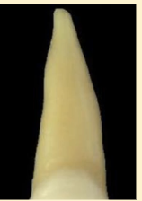 <p><mark data-color="blue" style="background-color: blue; color: inherit">maxillary central incisors #8 and #9; root shape</mark></p>