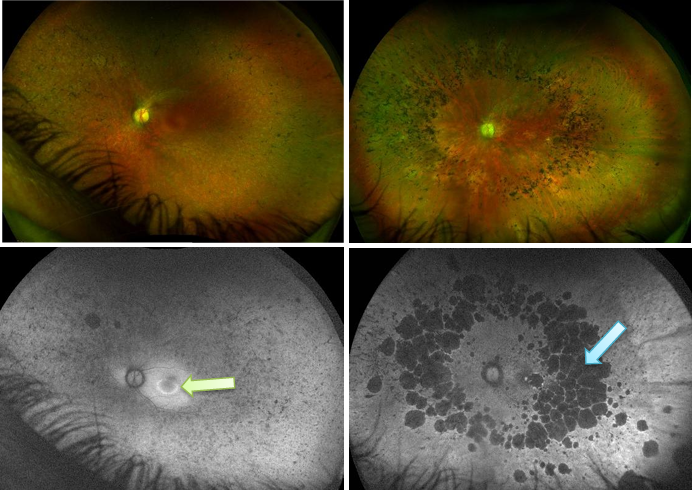 <p>What do you see here? These are 2 diff conditions (one on left has a colour fundus version above and FAF version helping see lesion better, and same for right):</p>