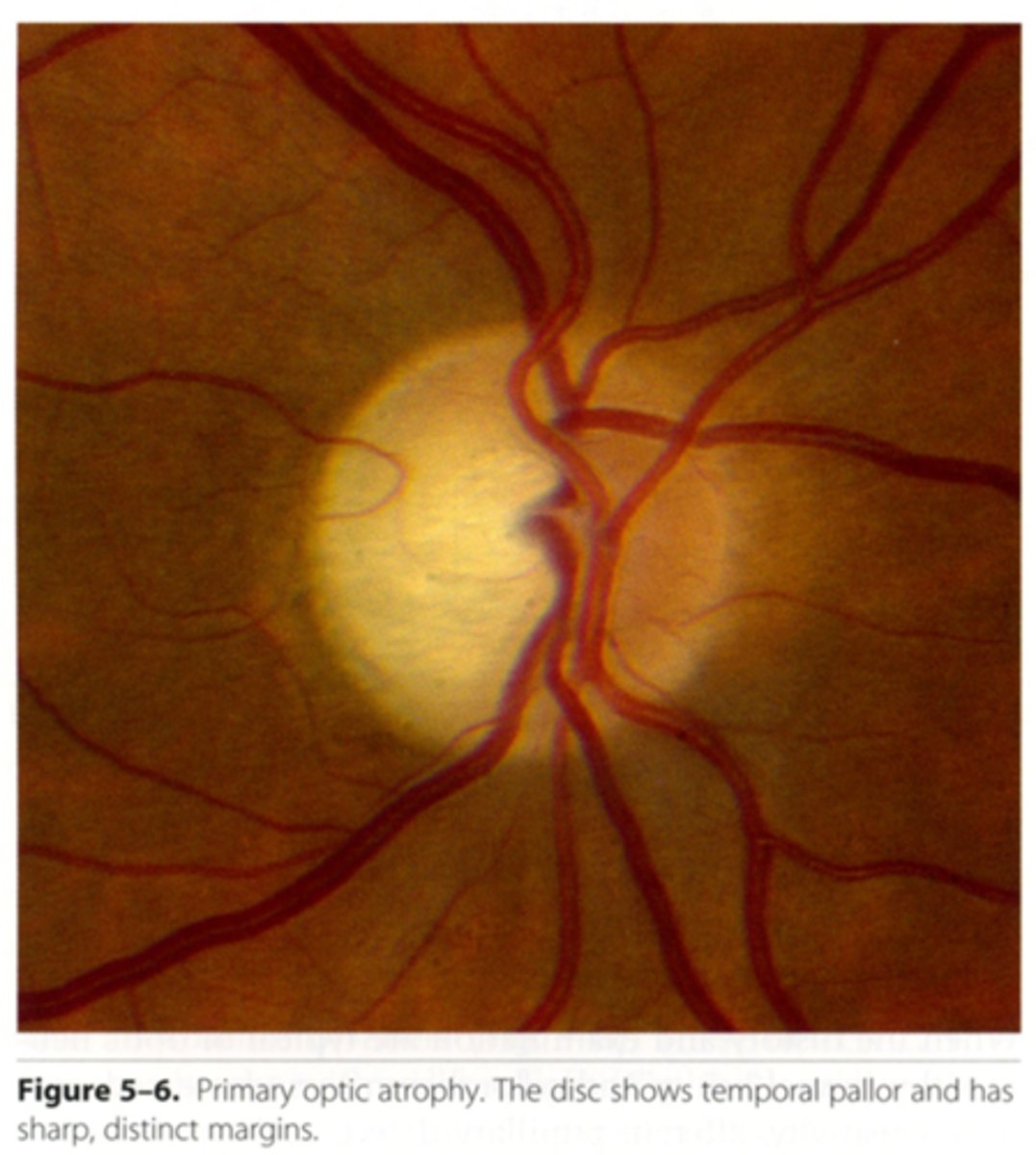 <p>AKA primary optic atrophy = lesion in the LGN to the ONH = SHARP disc margins, normal BV</p>