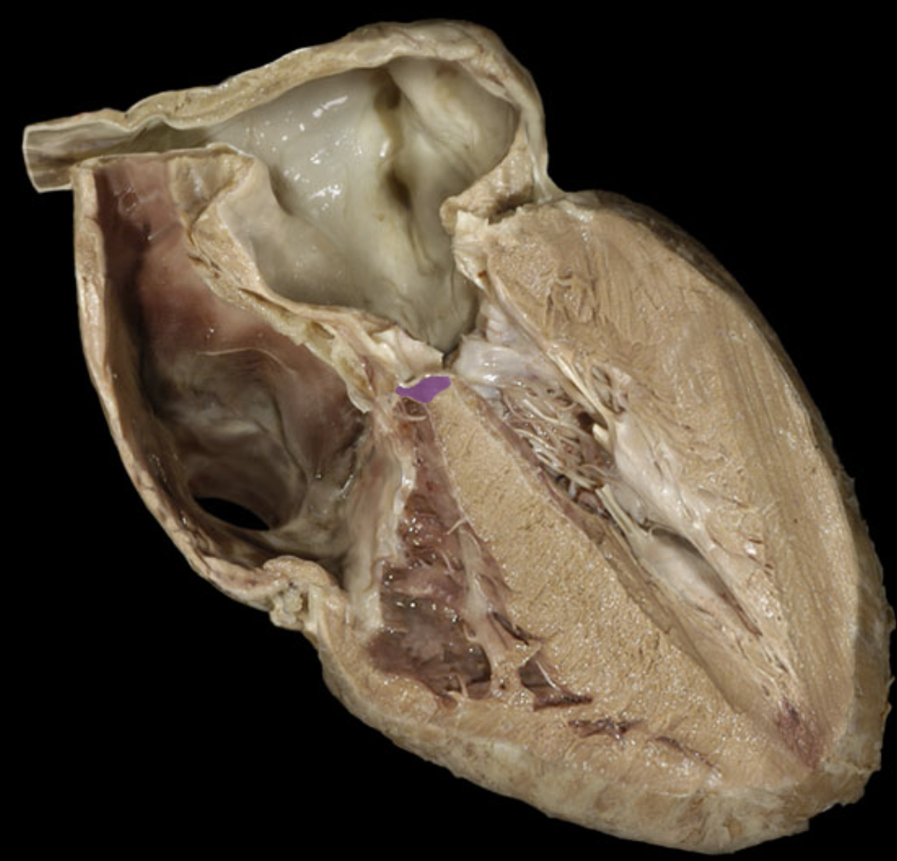 <p>Membranous Interventricular septum</p>