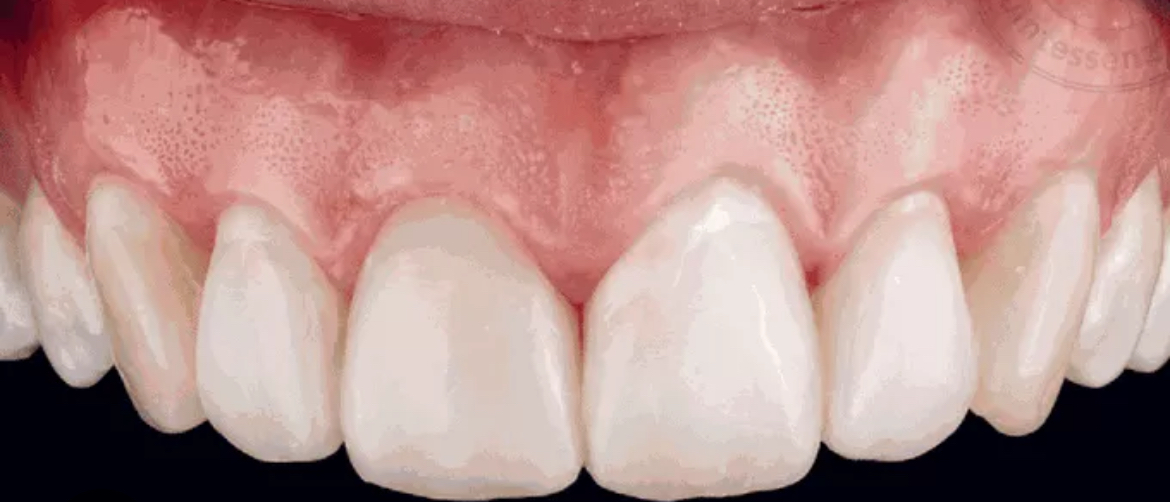 <p>The teeth at the front of the mouth.</p>