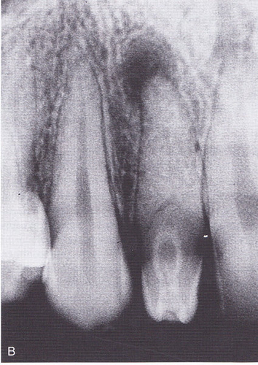<p>-also called dens invaginatus</p><p>-tooth within a tooth</p>
