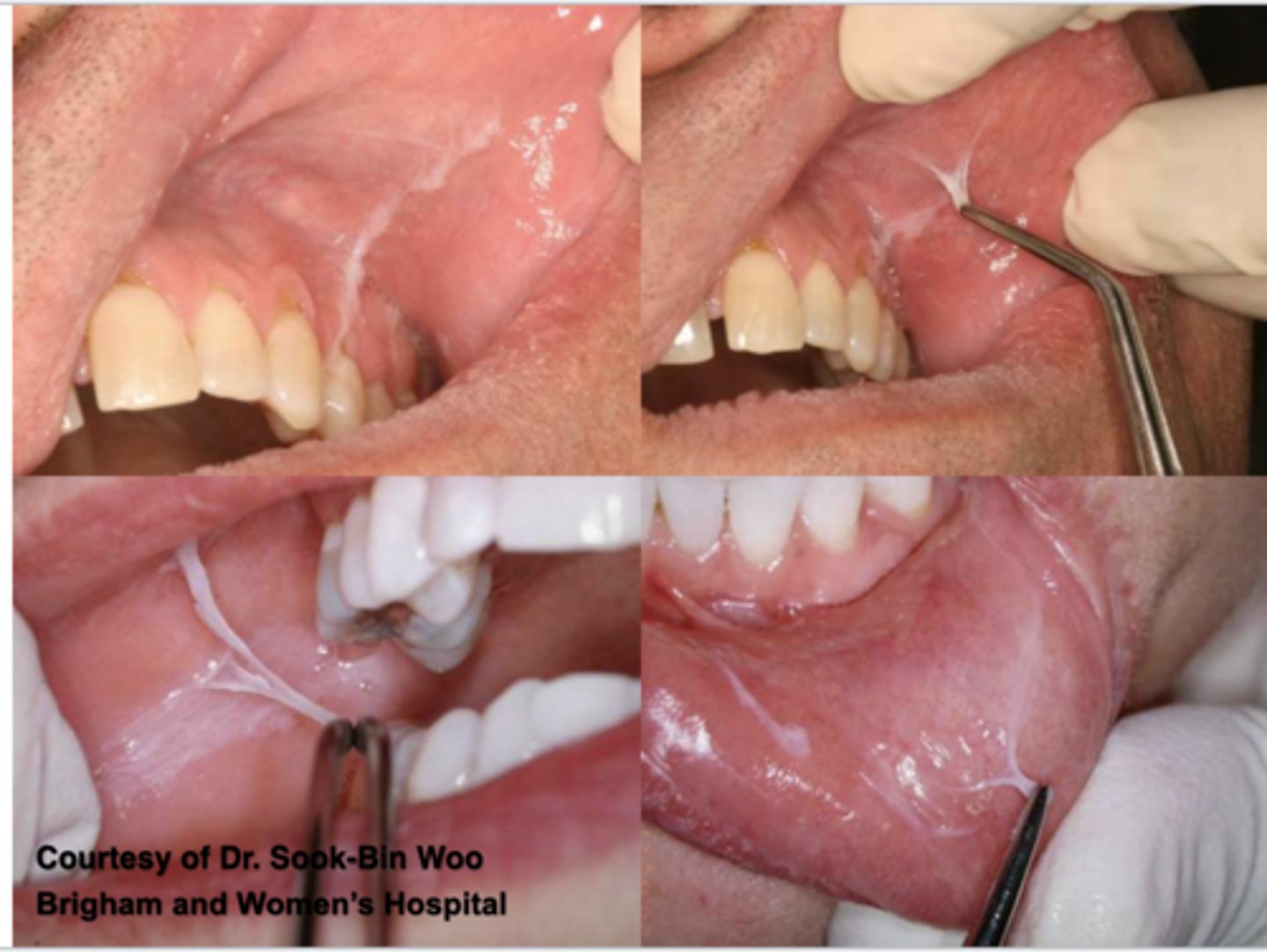<p>Patient reported rinsing with a new listerine mouthwash 3x/ day. The listerine is not alcohol free. Clinical findings are the sloughing off buccal mucosa as seen above. What do you suspect?</p>