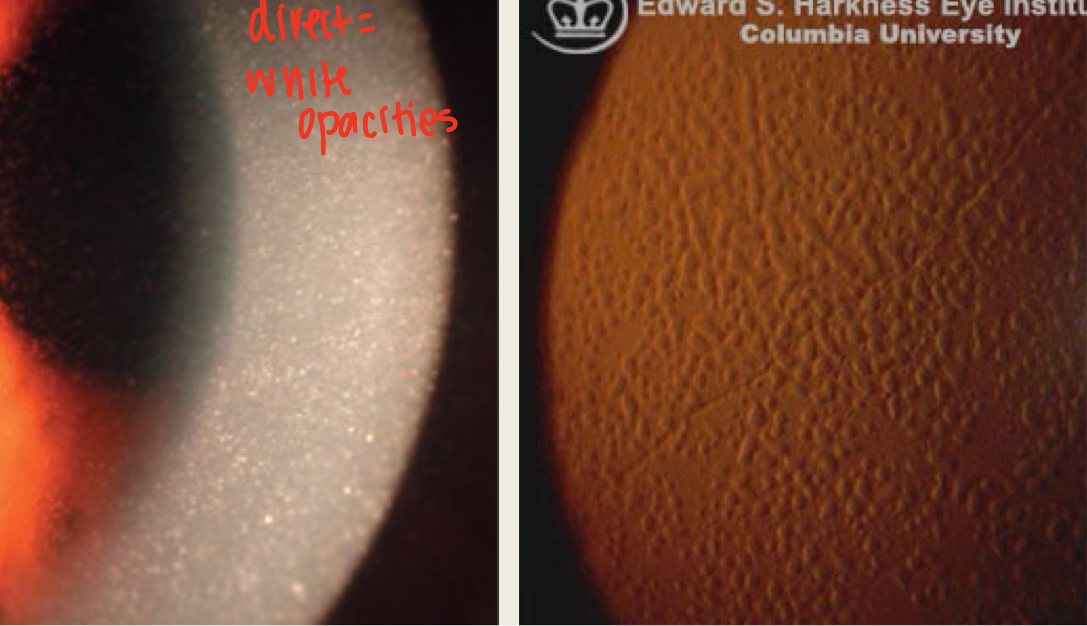 <ul><li><p>Most common of the epithelial-stromal dystrophies</p></li><li><p>autosomal dominant</p></li><li><p>Onset: first decade</p></li><li><p>Assoc. with systemic amyloidosis</p></li><li><p><strong>Pathophysiology</strong>: amyloid deposits accumulate between epithelial basement membrane and Bowman layer and the anterior stroma</p></li><li><p><strong>Symptoms</strong>: blurred vision and pain with recurrent corneal erosions</p></li><li><p><strong>Presentation</strong>: amyloid deposition in anterior stroma</p><ul><li><p>Corneal deposits will be r<em>efractile dots that coalesce to form linear lines</em> (makes lattice)</p></li><li><p>Over time corneal deposits will be surrounded by haze that will eventually fibrous = <em>opacification</em></p></li><li><p>Affects central cornea</p></li><li><p>Reduced corneal sensitivity</p></li></ul></li><li><p><span><strong>Complications</strong>: recurrent corneal erosions, blurred vision (due to haze)</span></p></li><li><p><span><strong>Treatment</strong>:</span></p><ul><li><p>observation</p></li><li><p>RCE tx</p></li><li><p>lamellar keratoplasty</p></li></ul></li></ul><p></p>