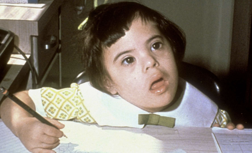 <p>Down Syndrome (Trisomy 21)</p>