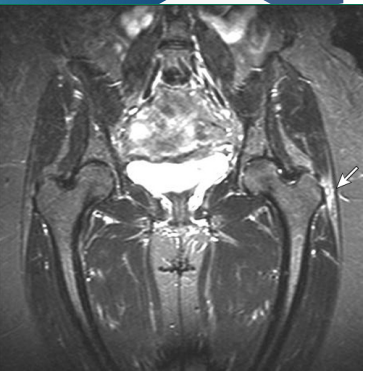 <p><strong>Greater Trochanteric Pain Syndrome: Treatment</strong></p><p>-S/S</p><ul><li><p>_______ hip pain</p></li><li><p>TTP over ________ trochanter</p></li><li><p>Pain increased with __________</p></li><li><p>ROM is ________</p></li></ul><p>-Diagnosis</p><ul><li><p>_______</p></li><li><p>Imaging is reserved for persistent sx or to r/o other conditions</p></li></ul><p>-Treatment</p><ul><li><p>Often ____ _________</p></li><li><p>Rest, ice, ________, stretching, __</p></li><li><p>Steroid injection</p></li></ul><p></p>