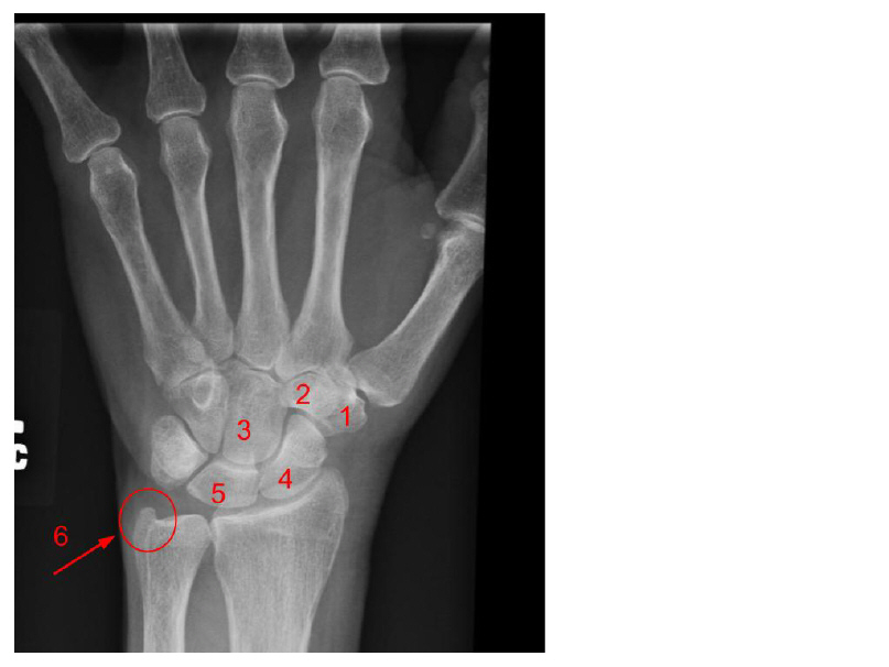 <p>What bone of the wrist is #2?</p><p>A. Hamate</p><p>B. Lunate</p><p>C. Trapezoid</p><p>D. Trapezium</p>