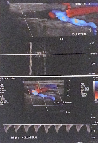 <p>in the top image, there is no flow detected by spectral doppler in the proximal arterial segment. Explain the flow direction documented by color and doppler flow in the collateral brachial artery distally (bottom image)</p>