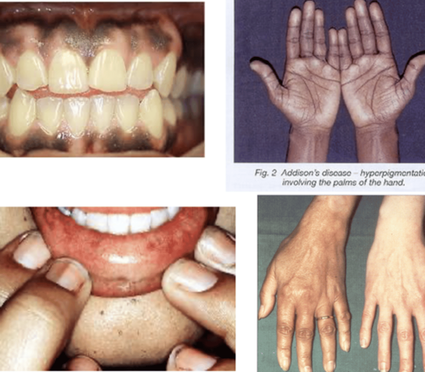 <p>It is driven by elevated ACTH levels (POMC precursor and MSH) leading to darkening of non-sun exposed areas (skin creases, pressure areas, and mucous membranes)</p>