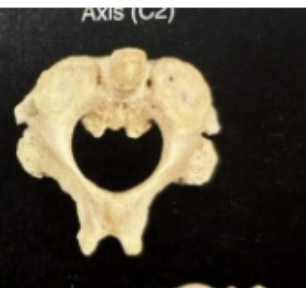 <p>Axis- large projection-dens</p>