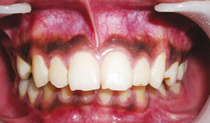 <p>dx</p>