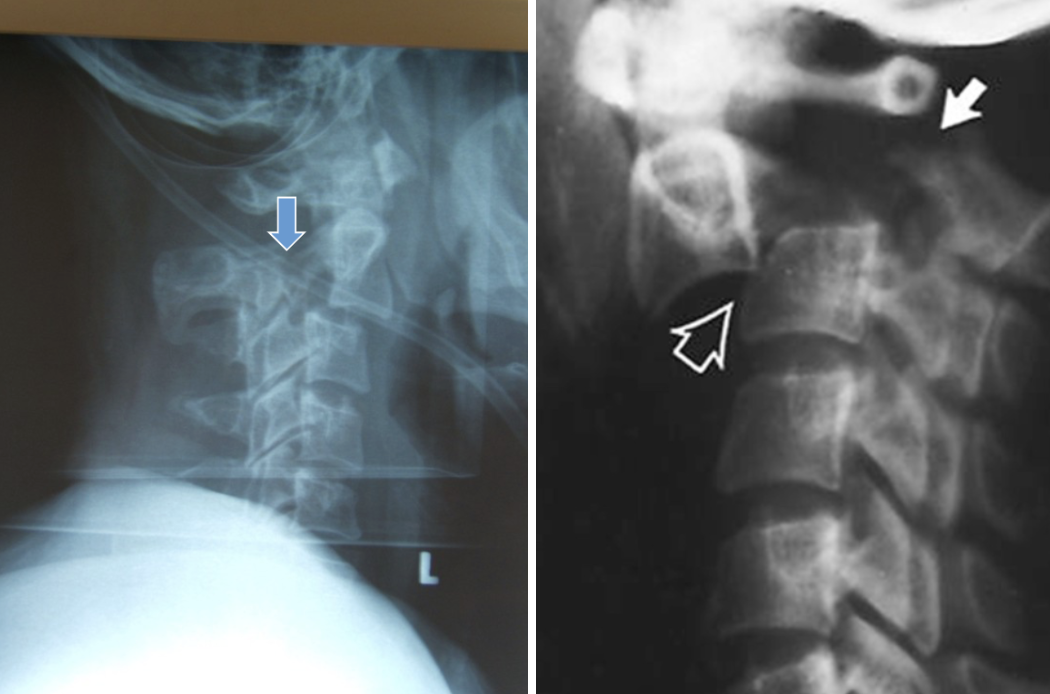 <p>Name this fracture</p>