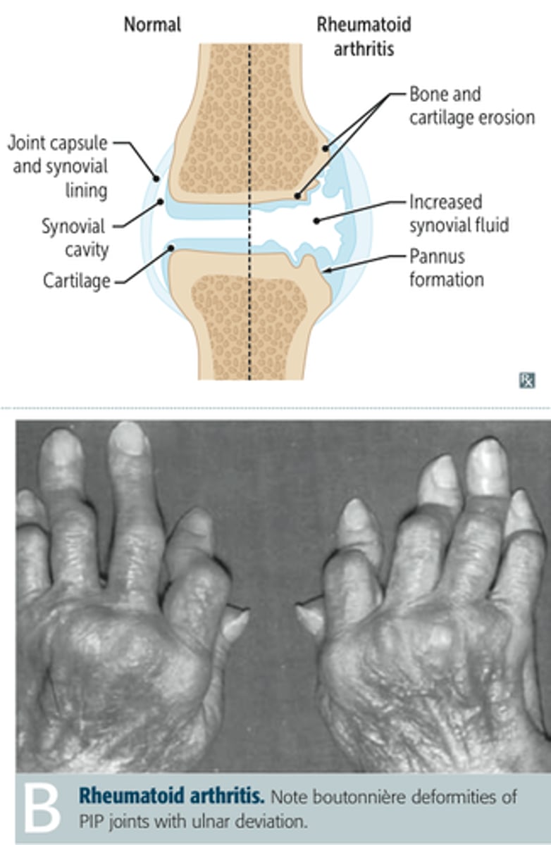 <p>▪Morning stiffness greater than 1 hour</p><p>▪Arthritis of 3 or more joint areas</p><p>▪Arthritis of hand joints</p><p>▪Symmetrical arthritis (involvement on both sides)</p><p>▪Rheumatoid nodules</p><p>▪RH factor (blood test)</p><p>▪X-ray changes</p><p>*need at least 4</p>