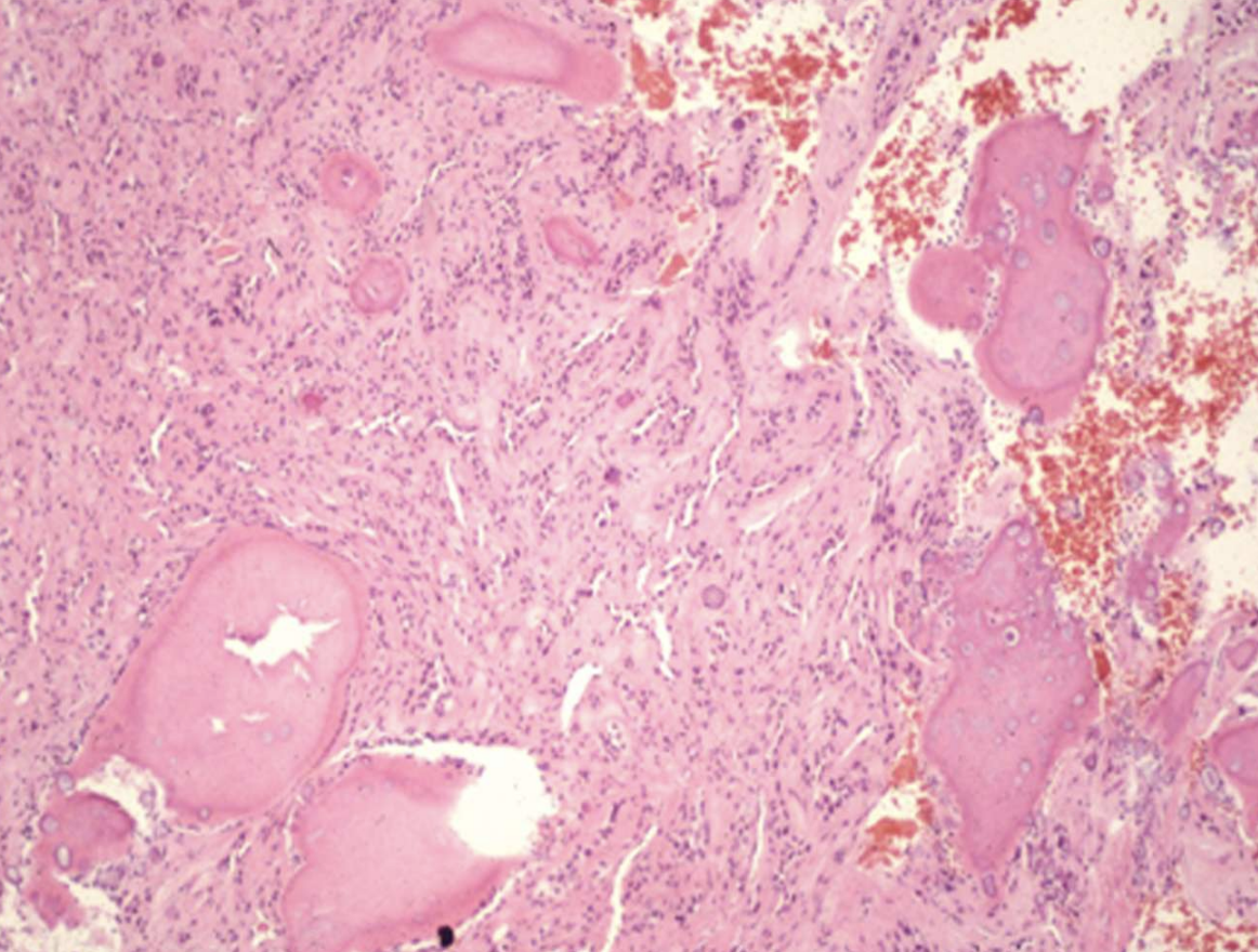 <p>what are histopathologic features of Calcifying Epithelial Odontogenic Tumor (Pindborg tumor)?</p>